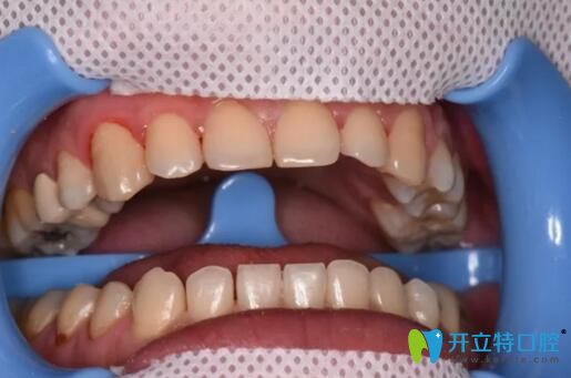 術(shù)前牙齒存在問題