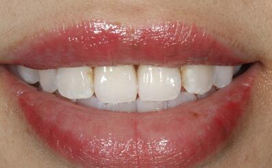 在鄭州森德口腔做了全瓷美容冠修復后她又可以開懷大笑了