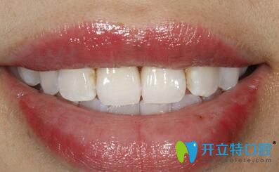 全瓷牙完成后口內(nèi)照片 全瓷牙完成后口內(nèi)照片