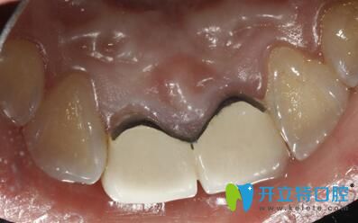 原烤瓷牙舌側(cè)觀 原烤瓷牙舌側(cè)觀