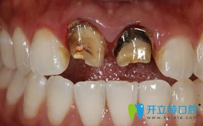 拆除原烤瓷牙后 拆除原烤瓷牙后
