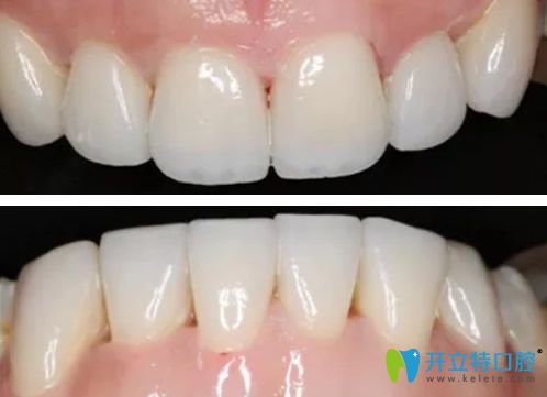 云浮拜爾口腔全瓷牙貼面效果