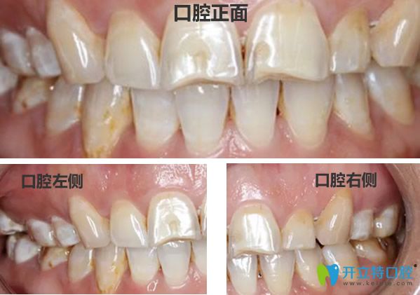 云浮拜爾口腔氟斑牙治療前