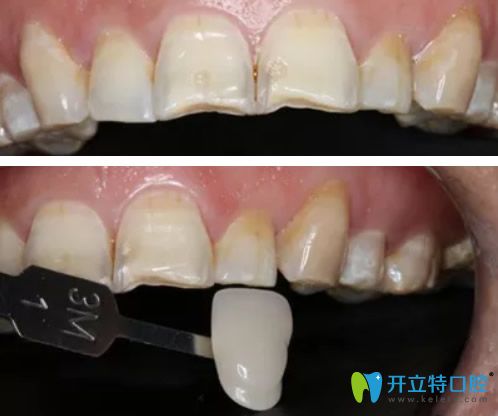 牙齒比色和全瓷牙貼面粘結(jié)