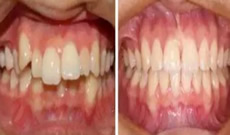 隱形矯正有用嗎？看自貢新橋口腔3D數(shù)碼隱形矯正案例效果