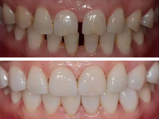 來(lái)通化愛(ài)德口腔做美加瓷貼面修復(fù)前 我牙齒暗黃牙列稀疏