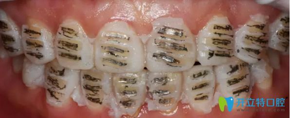 做瓷貼面前對牙齒進行打磨