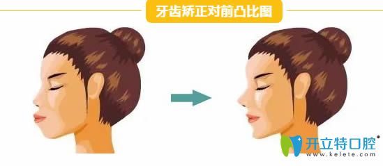 牙齒矯正能改變臉型嗎?西安小白兔口腔的王鴻應(yīng)告訴你真相