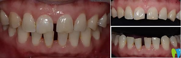 通化愛德口腔牙齒瓷貼面修復前