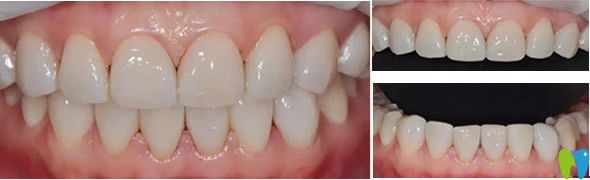 通化愛德口腔瓷貼面修復效果