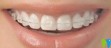 寧波牙博士陶瓷托槽矯正器