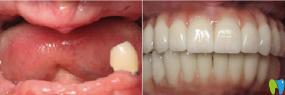 深圳同步齒科全口牙種植效果案例 深圳同步齒科全口牙種植效果案例