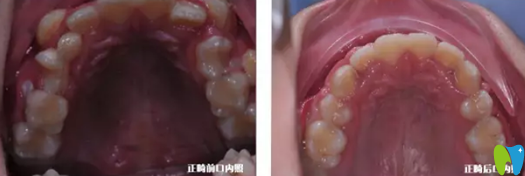兒童牙齒正畸案例：上牙正畸前后對比照