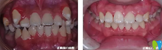 漢中小虎牙口腔兒童牙齒正畸前后對比圖