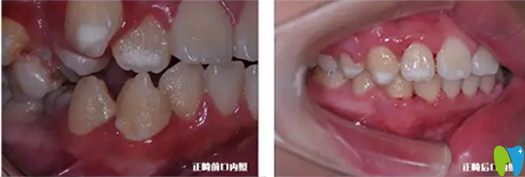 漢中小虎牙口腔兒童牙齒正畸案例：上牙虎牙出正畸前后對比圖
