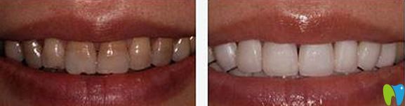 常州北極星口腔洗牙前后效果對比圖