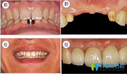 深圳拜博口腔黎強醫(yī)生牙齒種植經(jīng)典案例