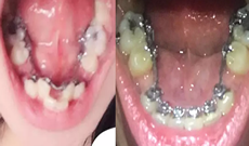 深圳格倫菲爾（唐?。┛谇谎例X矯正1年多 變美八個(gè)檔次