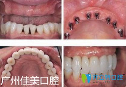廣州佳美口腔半口牙缺失種植效果 廣州佳美口腔半口牙缺失種植效果