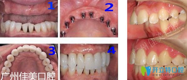 廣州佳美口腔牙齒種植+齙牙矯正效果對比圖