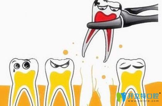 拔牙后的注意事項(xiàng)有哪些？威海舒好口腔劉炳黎院長來解答