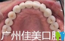 佳美口腔半口牙種植效果