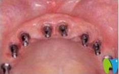 種植牙齒前先讓種植體固定在牙槽骨內(nèi)
