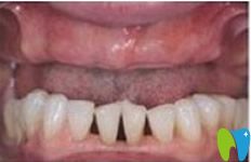 廣州佳美口腔牙齒種植前
