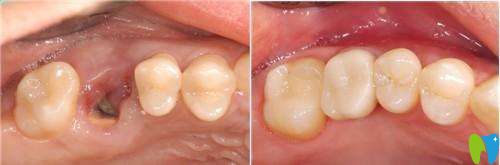 威海舒好口腔怎么樣？種植牙案例及前后對(duì)比效果圖展示