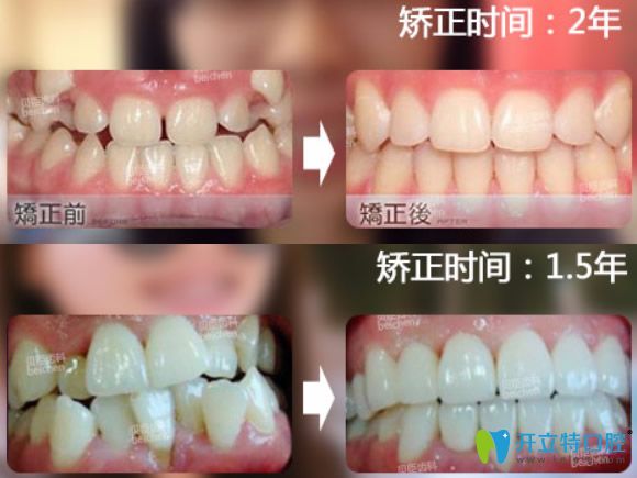 成都貝臣齒科價格表,種牙1800元起+矯正4999起,牛王廟地鐵站旁