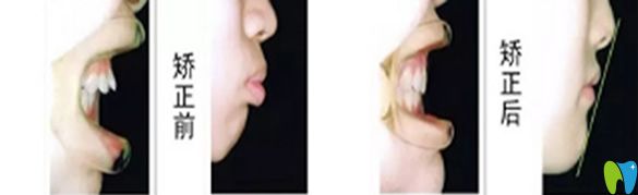 牙齒矯正前后效果對(duì)比圖 牙齒矯正前后效果對(duì)比圖
