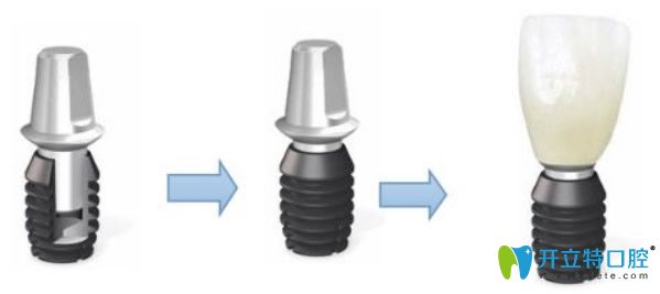 美國(guó)百康種植體的優(yōu)點(diǎn)有哪些及種植一顆牙的價(jià)格要多少錢