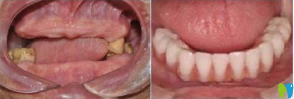 全口牙缺失怎么辦？合肥美奧口腔全口種植牙案例效果賞析