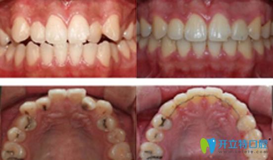 太平洋口腔牙齒錯頜真人案例對比圖