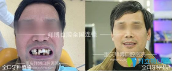 拜博口腔多顆牙缺失種植案例 拜博口腔多顆牙缺失種植案例