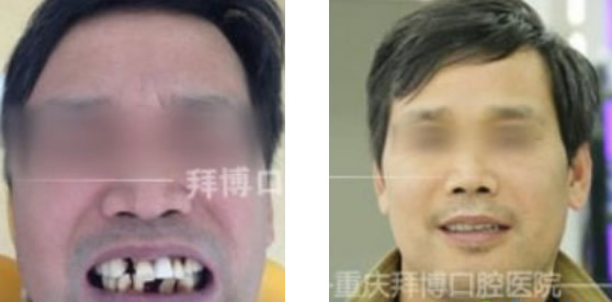 重慶拜博口腔種植牙齒價格和技術(shù)怎么樣 真人案例現(xiàn)場解答
