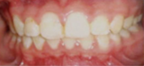 孩子換牙后牙齒不整齊怎么辦 常州太平洋口腔是如何矯正的