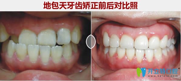 西安小白兔口腔地包天牙齒矯正對(duì)比照