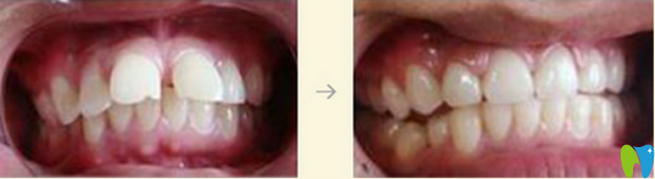 重慶拜博口腔牙齒矯正效果案例