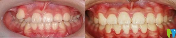 太平洋口腔牙齒矯正前后對(duì)比圖