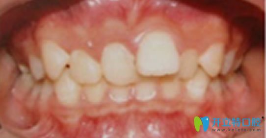 常州太平洋口腔牙齒矯正前的照片