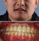 青島口腔哪家好？可恩口腔萬金華種植牙案例效果展示