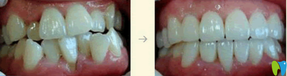 深圳瑞爾齒科矯正牙齒效果案例