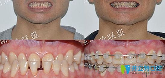 廣州康圓口腔牙齒正畸案例對(duì)比圖