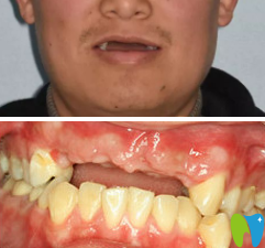 青島可恩口腔種植牙