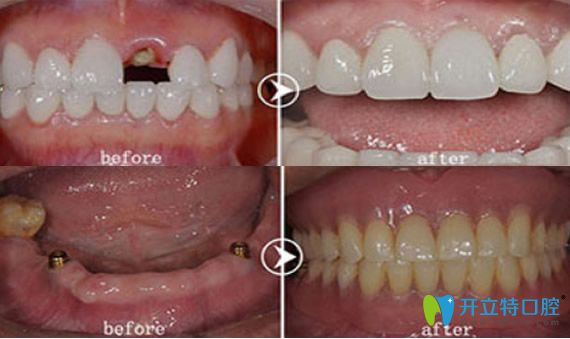 深圳愛康健口腔好不好？愛康健種植牙來證明