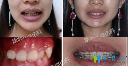 廣州康圓口腔牙齒矯正90天排齊效果圖