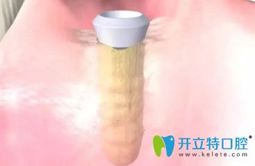 種植體與牙槽骨結(jié)合好后要安裝基臺