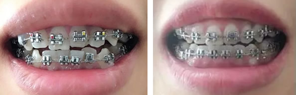 我在深圳瑞爾齒科做了牙齒矯正 價(jià)格和效果對(duì)比圖都在文中