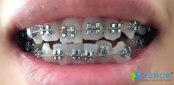 金屬托槽矯正牙齒價格比較實惠